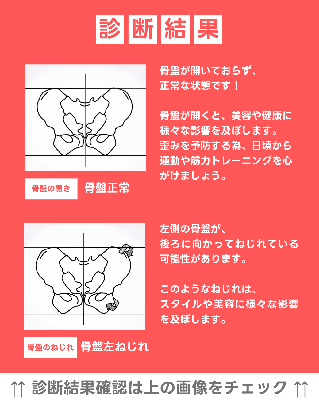 骨盤正常 左骨盤捻じれ