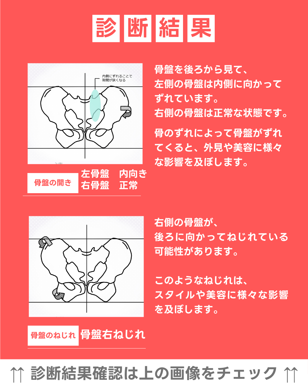 左骨盤　内向き　右骨盤　正常 右骨盤捻じれ