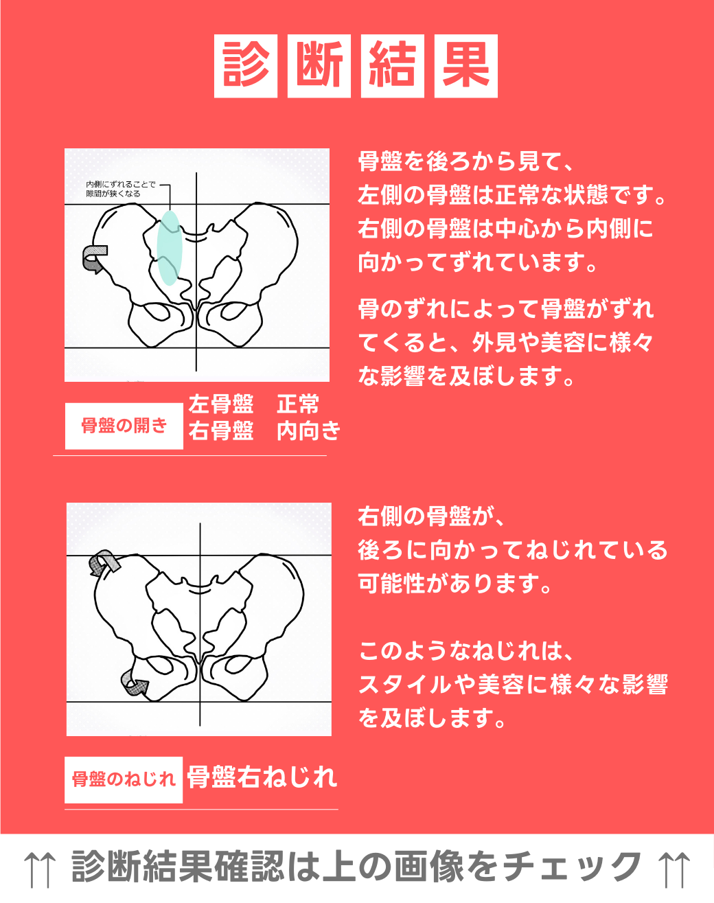 左骨盤　正常　右骨盤　内向き 右骨盤捻じれ