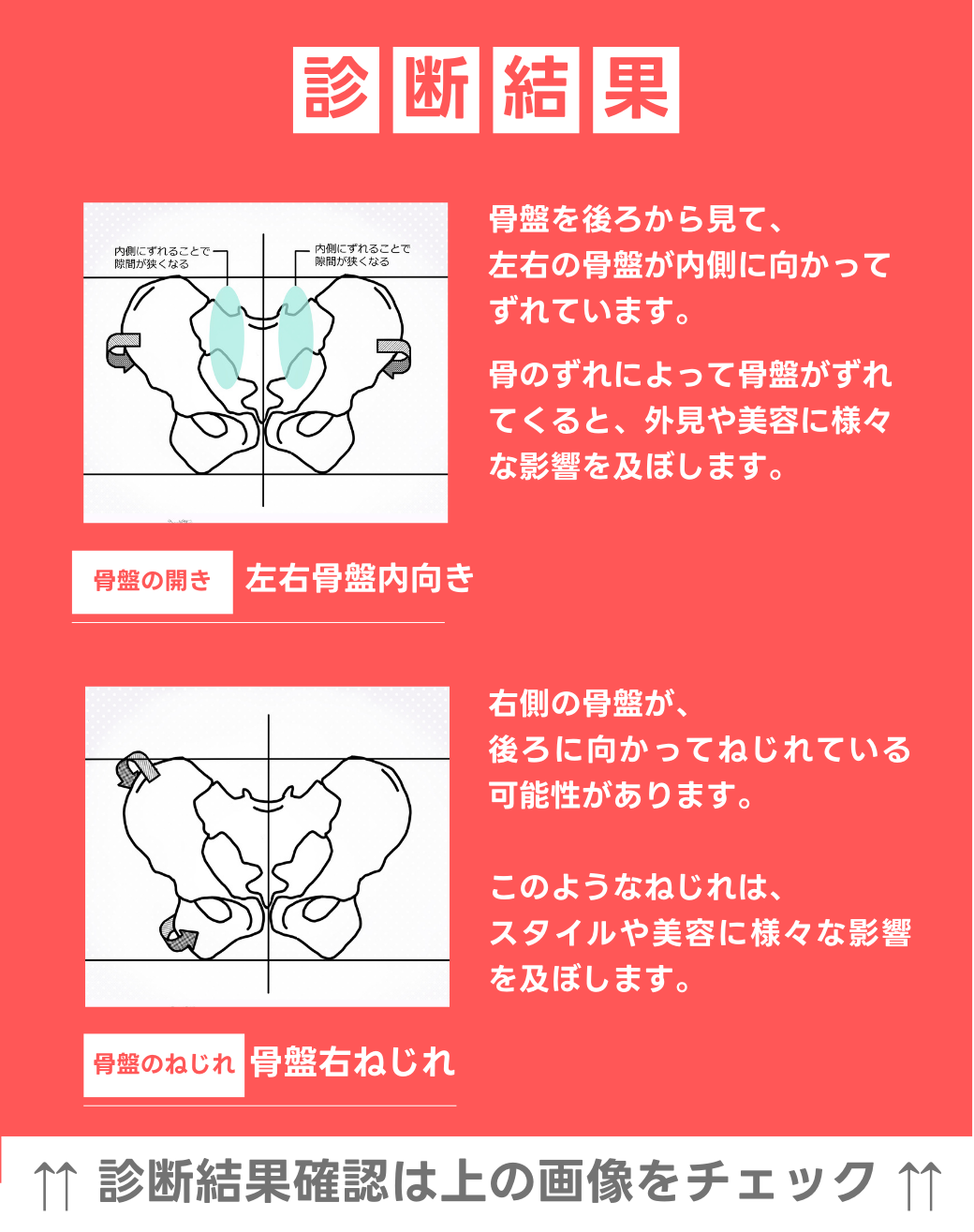左右骨盤　内向き 右骨盤捻じれ