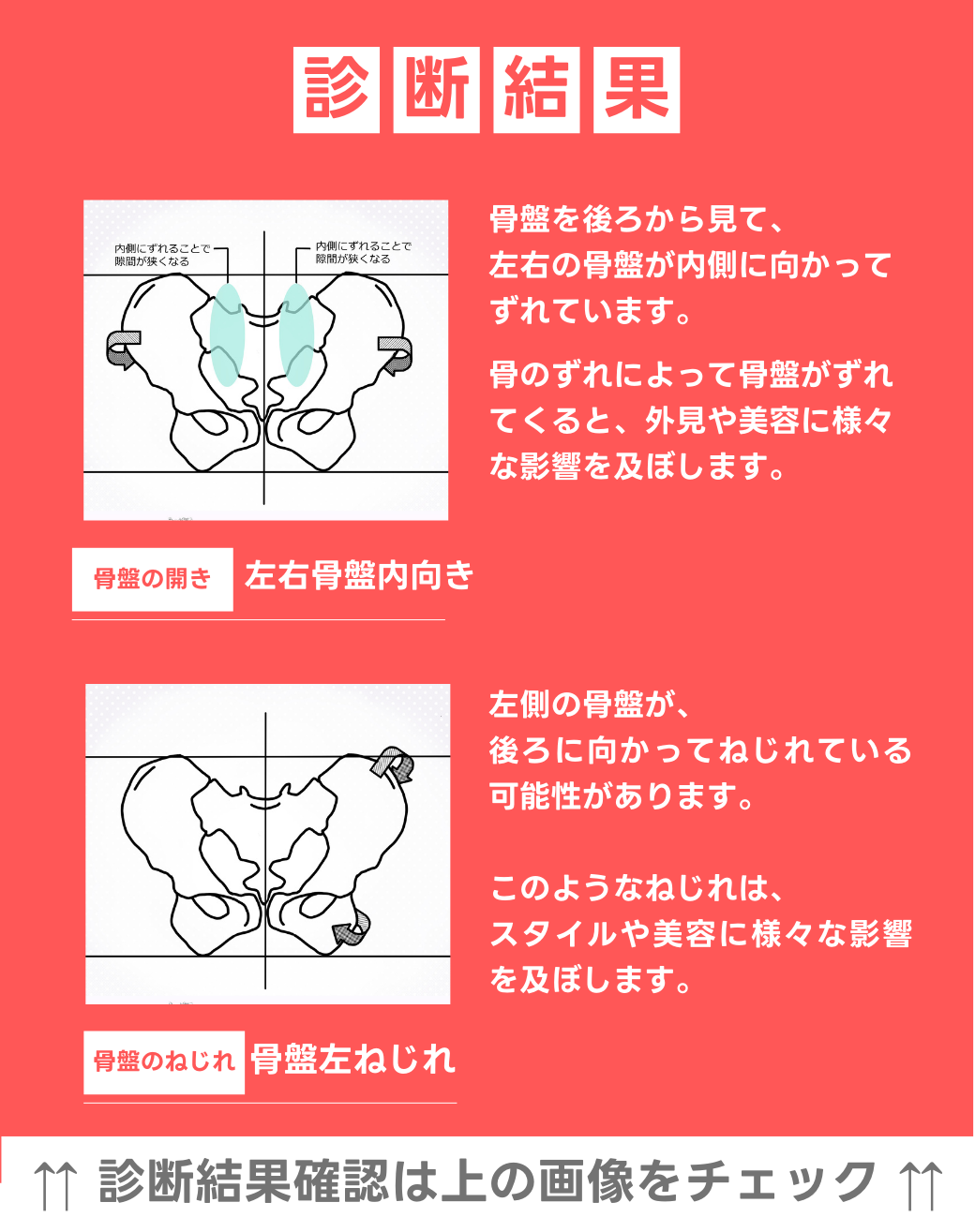 左右骨盤　内向き 左骨盤捻じれ