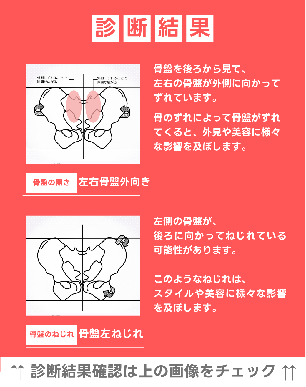 左右骨盤　外向き 左骨盤捻じれ