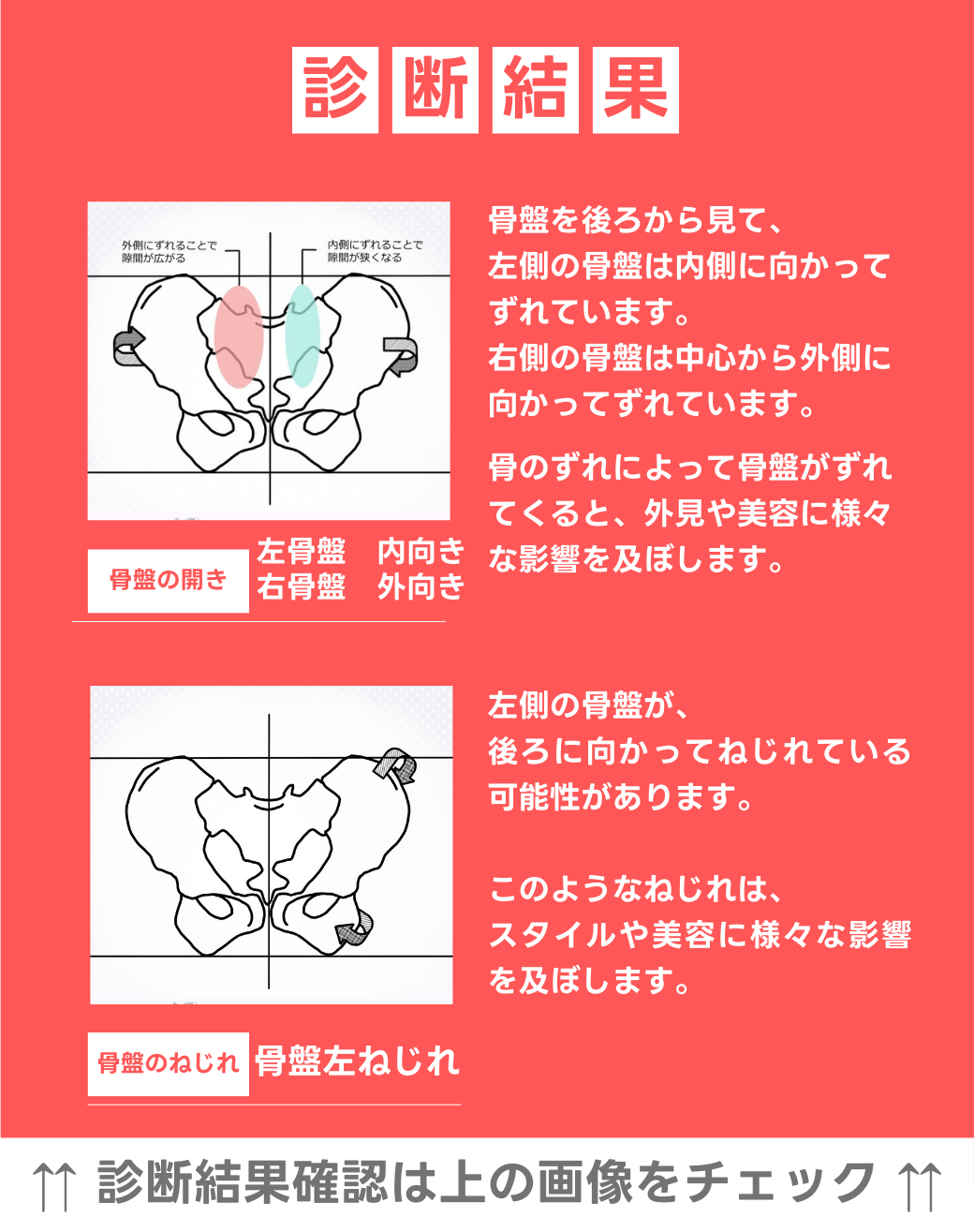 左骨盤　内向き　右骨盤　外向き 左骨盤捻じれ