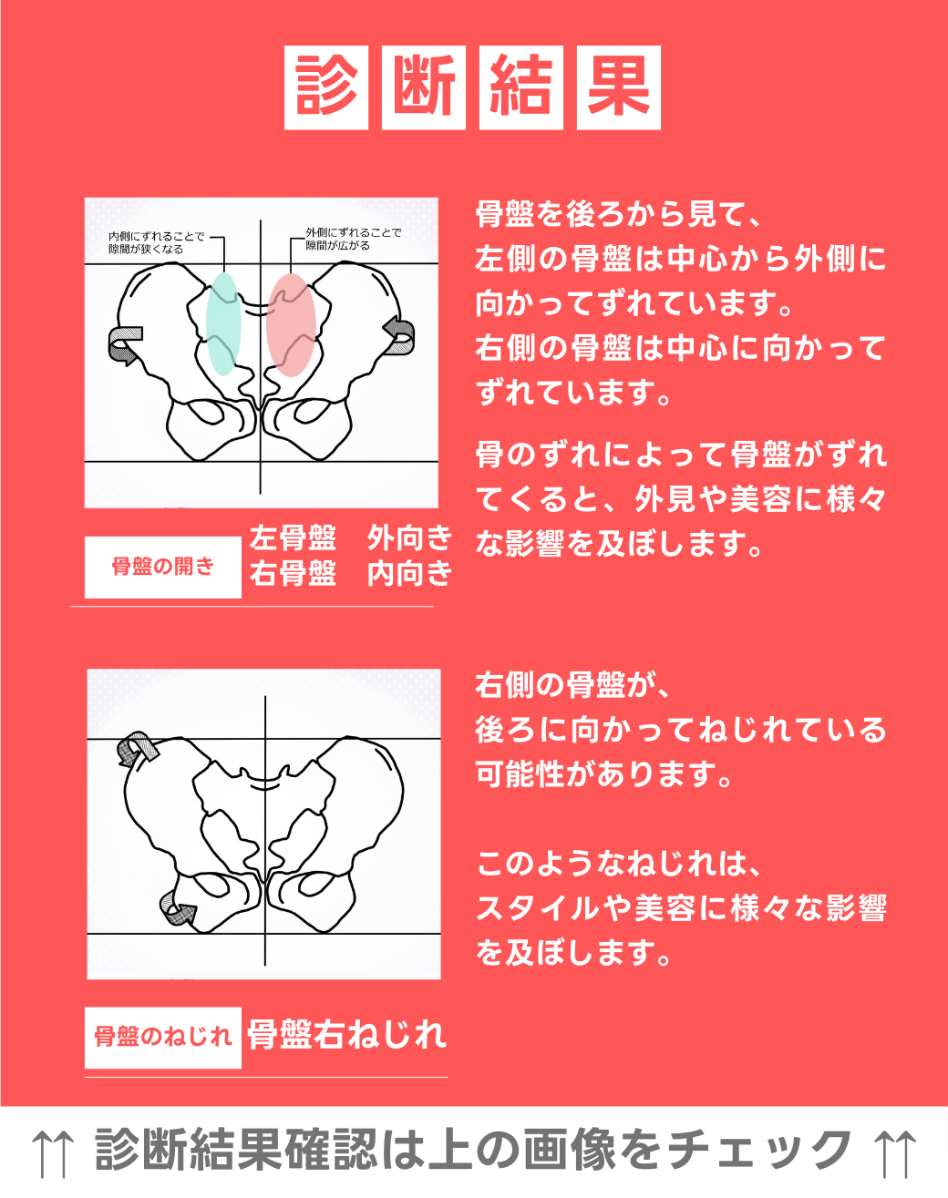 左骨盤　外向き　右骨盤　内向き 右骨盤捻じれ