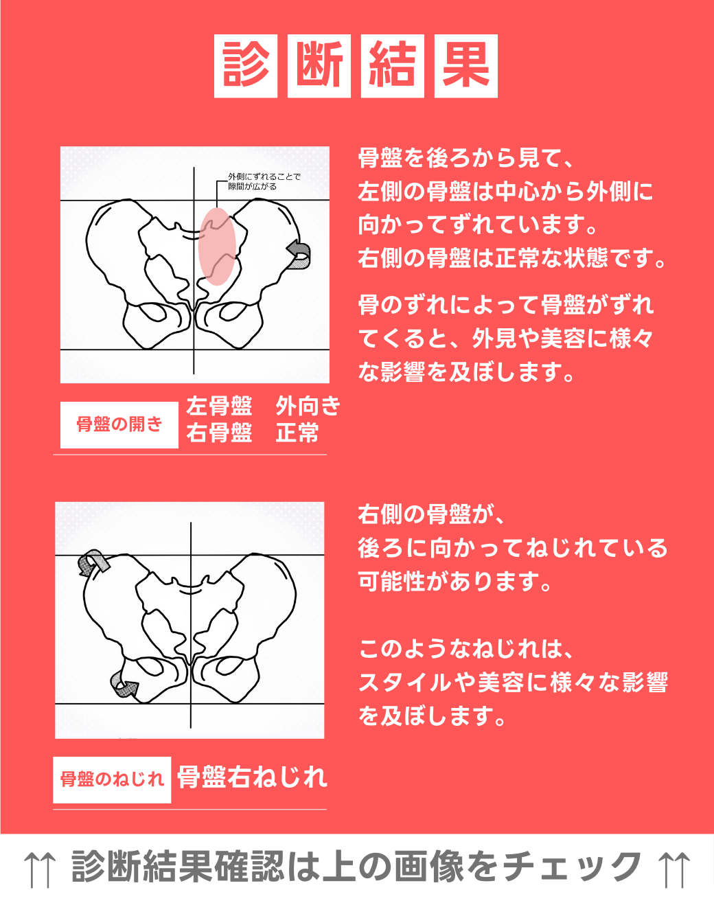 左骨盤　外向き　右骨盤　正常 右骨盤捻じれ
