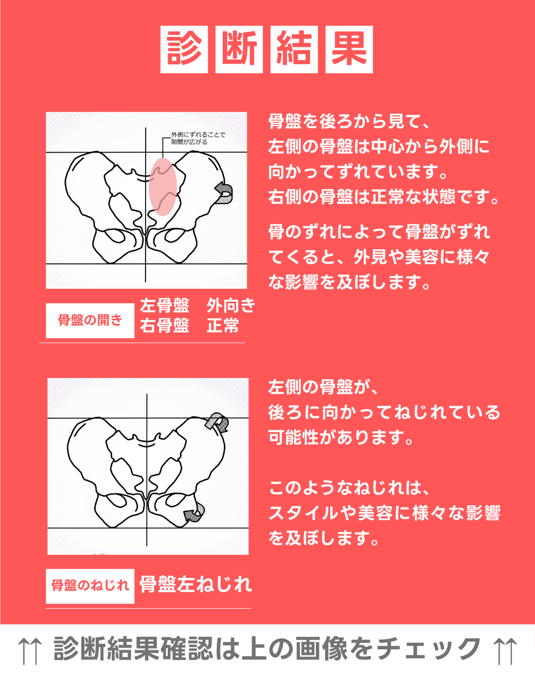 左骨盤　外向き　右骨盤　正常 左骨盤捻じれ